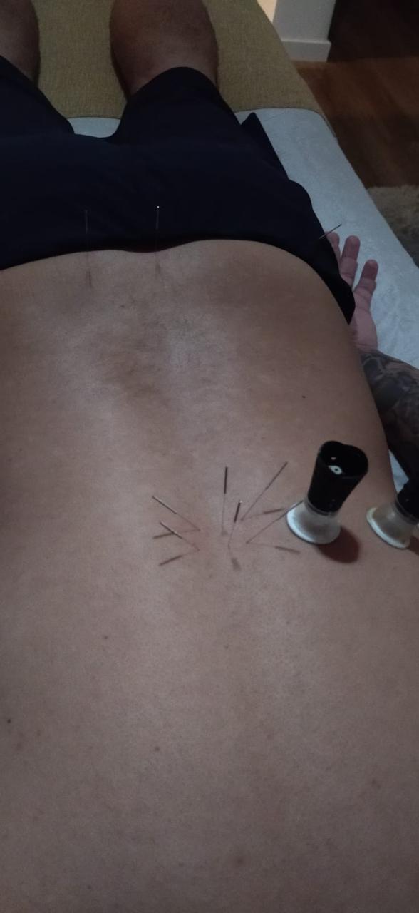 Sessão de acupuntura e ventosaterapia