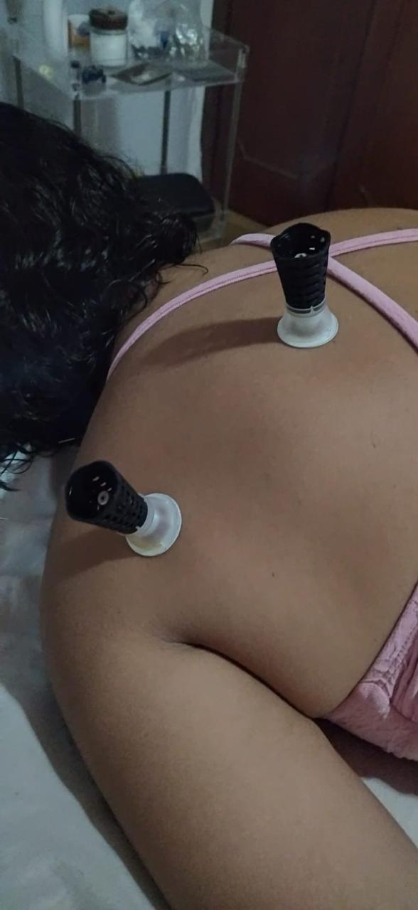Aplicação de ventosaterapia durante atendimento